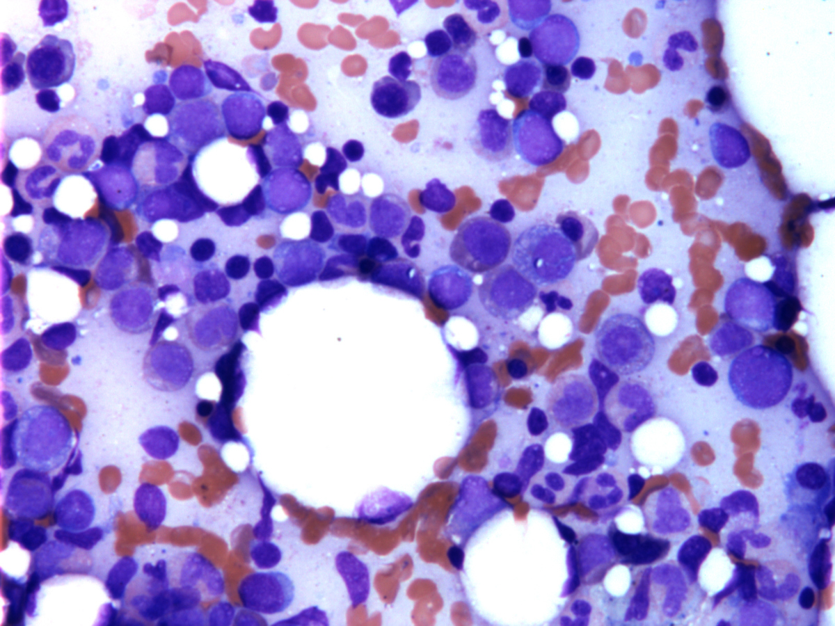 Bone marrow aspirate